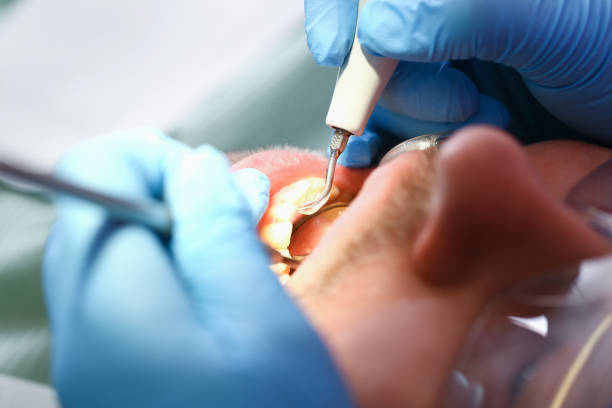 Best Emergency Tooth Extraction in Meeker, CO