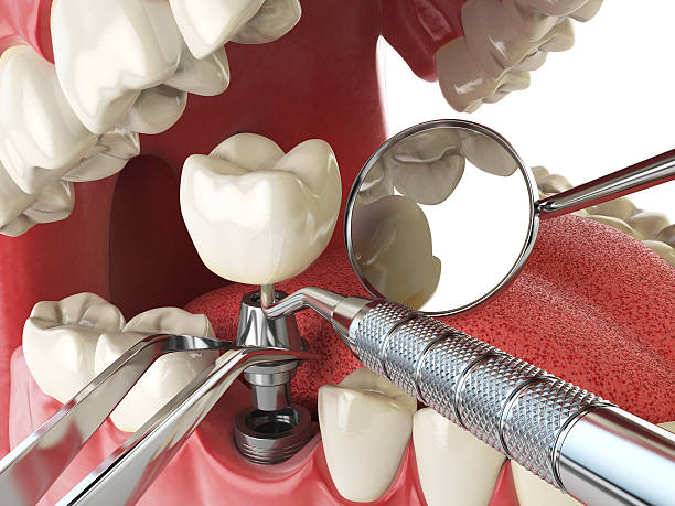 Best Emergency Tooth Extraction in Meeker, CO